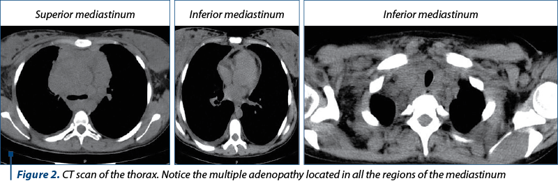 Figure 2. CT scan of the thorax. Notice the multiple adenopathy located in all the regions of the me