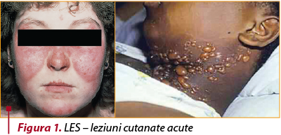 Figura 1. LES – leziuni cutanate acute