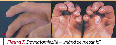 Figura 7. Dermatomiozită – „mână de mecanic”