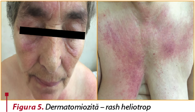 Figura 5. Dermatomiozită – rash heliotrop
