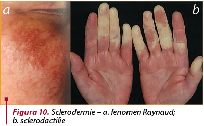 Figura 10. Sclerodermie – a. fenomen Raynaud; 