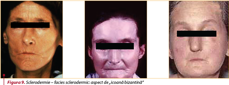 Figura 9. Sclerodermie – facies sclerodermic