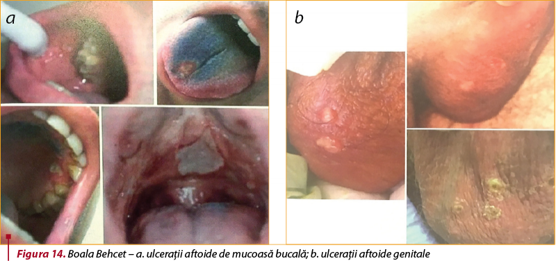 Figura 14. Boala Behcet – a. ulceraţii aftoide de mucoasă bucală; b. ulceraţii aftoide genitale