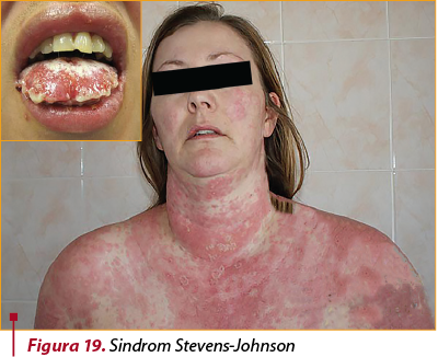 Figura 19. Sindrom Stevens-Johnson