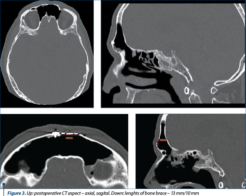 Figure 3. Up: postoperative CT aspect – axial, sagital. Down: lenghts of bone brace – 13 mm/10 mm