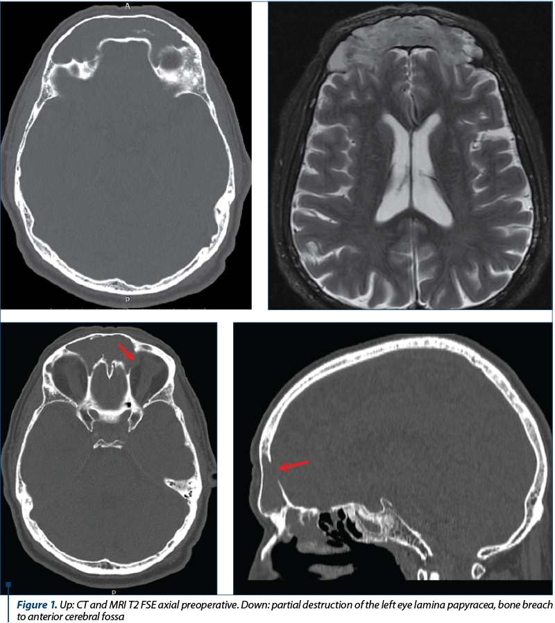 Figure 1. Up: CT and MRI T2 FSE axial preoperative. Down: partial destruction of the left eye lamina papyracea, bone breach to anterior cerebral fossa