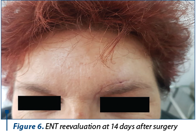 Figure 6. ENT reevaluation at 14 days after surgery