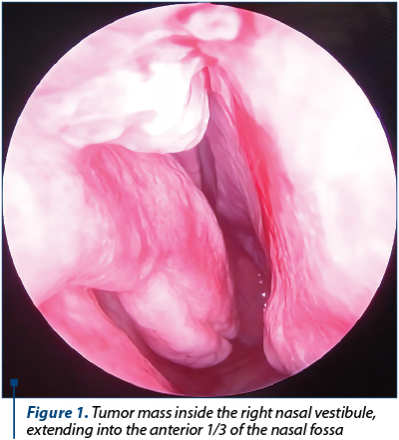 Figure 1. Tumor mass inside the right nasal vestibule, extending into the anterior 1/3 of the nasal fossa