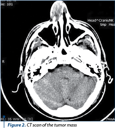 Figure 2. CT scan of the tumor mass