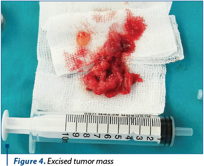 Figure 4. Excised tumor mass