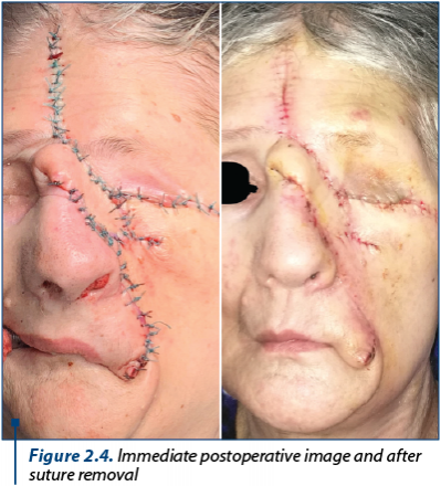 Figure 2.4. Immediate postoperative image and after suture removal 