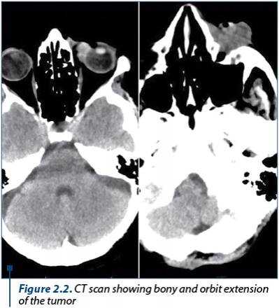 Figure 2.2. CT scan showing bony and orbit extension of the tumor 