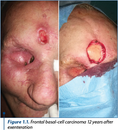 Figure 1.1. Frontal basal-cell carcinoma 12 years after exenteration