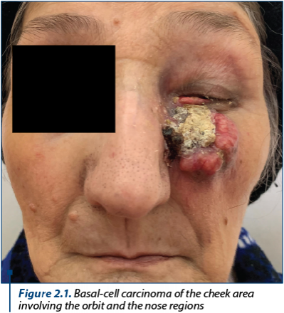 Figure 2.1. Basal-cell carcinoma of the cheek area involving the orbit and the nose regions
