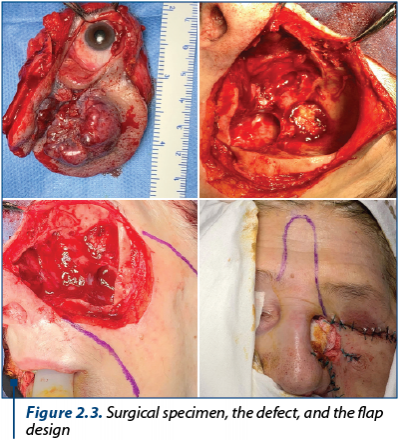 Figure 2.3. Surgical specimen, the defect, and the flap design