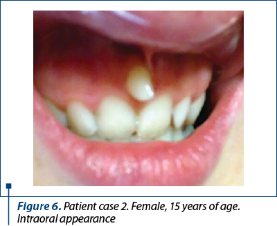 Figure 6. Patient case 2. Female, 15 years of age. Intraoral appearance