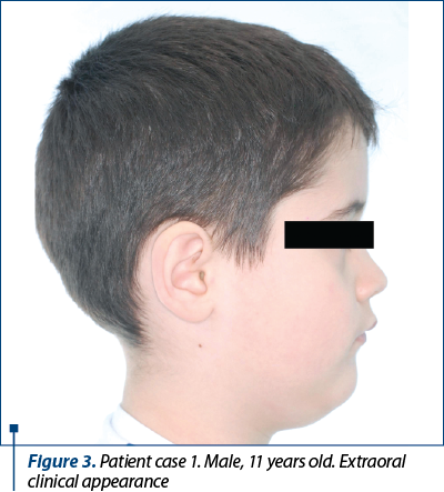 Figure 3. Patient case 1. Male, 11 years old. Extraoral clinical appearance