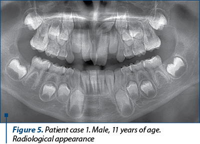 Figure 5. Patient case 1. Male, 11 years of age. Radiological appearance