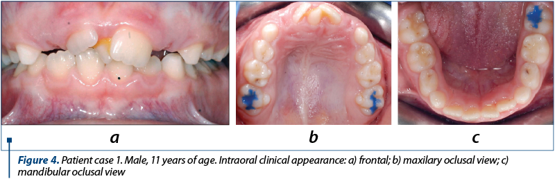 Figure 4. Patient case 1. Male, 11 years of age. Intraoral clinical appearance: a) frontal; b) maxilary oclusal view; c) mandibular oclusal view