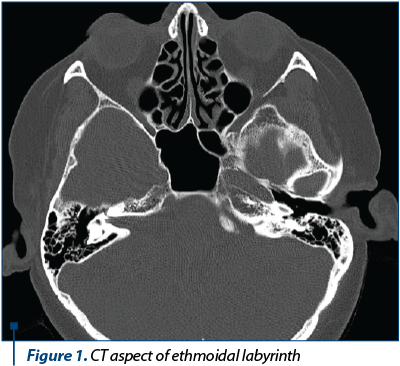 Figure 1. CT aspect of ethmoidal labyrinth