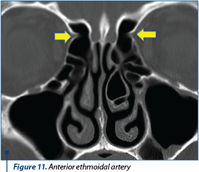 Figure 11. Anterior ethmoidal artery