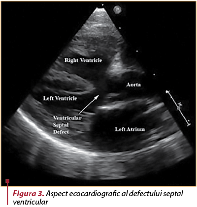 Figura 3. Aspect ecocardiografic al defectului septal ventricular