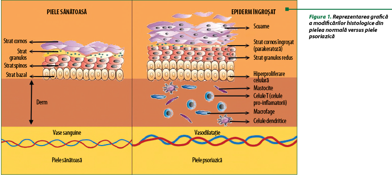 Figura 1. Reprezentarea grafică a modificărilor histologice din pielea normală versus piele psoriazi