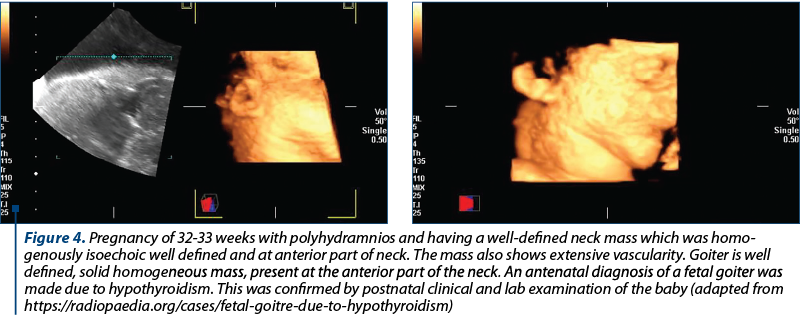 Figure 4. Pregnancy of 32-33 weeks with polyhydramnios and having a well-defined neck mass which was homo­genously iso­echoic well defined and at anterior part of neck. The mass also shows extensive vascularity. Goiter is well defined, solid ho­mo­ge­neous mass, present at the anterior part of the neck. An antenatal diagnosis of a fetal goiter was made due to hypothyroidism. This was confirmed by postnatal clinical and lab examination of the baby (adapted from https://radiopaedia.org/cases/fetal-goitre-due-to-hypothyroidism)