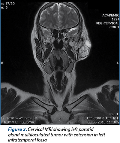 Figure 2. Cervical MRI showing left parotid gland multiloculated tumor with extension in left infratemporal fossa