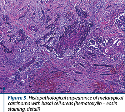 Figure 5. Histopathological appearance of metatypical carcinoma with basal cell areas (hematoxylin – eosin staining, detail)