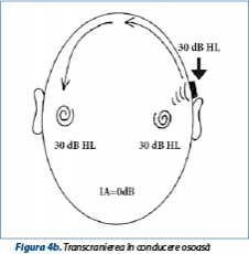 Figura 4b. Transcranierea în conducere osoasă