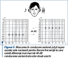 Figura 5. Mascarea în conducere aeriană (căşti supra­au­rale) este necesară pentru fiecare frecvenţă la care exis­tă diferenţe mai mari de 40 dB HL între pragurile din con­du­cerea aeriană ale celor două urechi