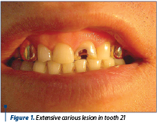 Figure 1. Extensive carious lesion in tooth 21 