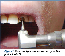Figure 2. Root canal preparation to insert glass fiber post in tooth 21 