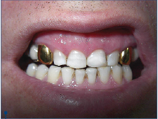 Figure 5. Final aspect of aesthetic direct resin composite restoration in tooth 21