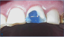 Figure 4. Total-etch technique for direct resin composite restoration in tooth 21