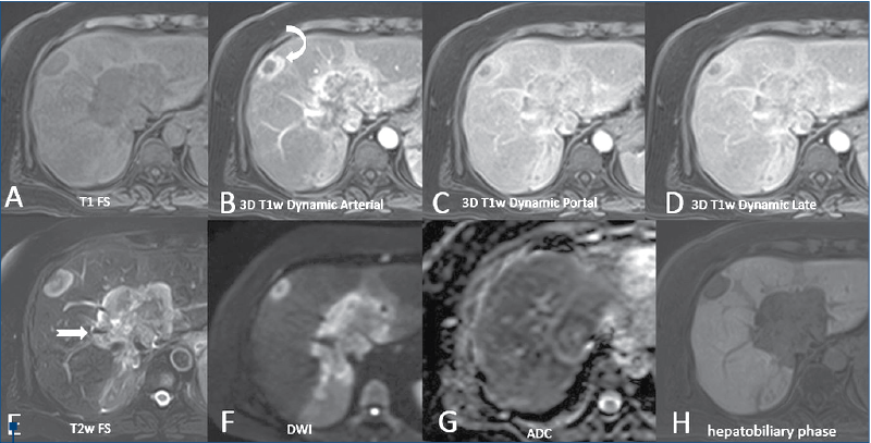 Figure 2. S.C., a 57-year-old female. MRI evaluation. Large central liver mass developed around the inferior vena cava and the hepatic veins. Hypersignal ring on T2 (E) and T1 FS (A) acquisition with a center that has an intermediate to hyposignal appearance. Important restriction of water-hypersignal DWI (F) and hypo-ADC (G). 3D T1w dynamic acquisitions show peripheral rim-like enhancement in arterial phase (B), followed by slow filling-in in the portal (C) and late phase (D). Note the presence of daughter lesion with the same characteristics of the main mass that associates capsular retraction (curved arrow). Both liver tumors appear hypointense in the hepatobiliary phase (H) 
