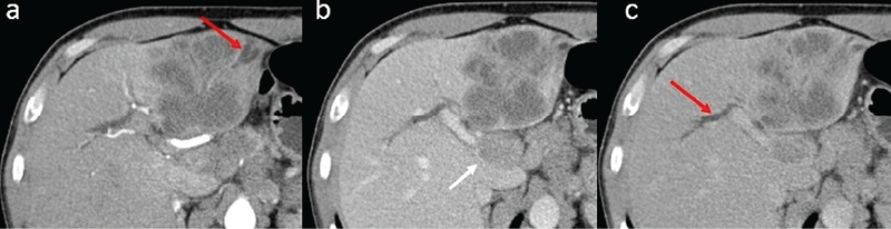 Figure 3. B.I., a 51-year-old male. Contrast enhanced CT in arterial phase (a), portal phase (b) and equilibrium phase (c) showing a large hepatic mass located in the left lobe with early inhomogeneous peripheric enhancement on arterial phase, followed by slow progressive centripetal incomplete filling on portal and equilibrium phase. Note the biliary dilatation (red arrows), and metastatic lymph nodes (white arrow). The immunohistological result was moderately differentiated adenocarcinoma