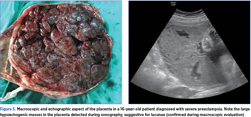 Figure 5. Macroscopic and echographic aspect of the placenta in a 16-year-old patient diagnosed with severe preeclampsia. Note the large hypoechogenic masses in the placenta detected during sonography, suggestive for lacunae (confirmed during macroscopic evaluation)