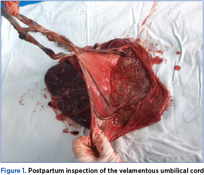 Figure 1. Postpartum inspection of the velamentous umbilical cord